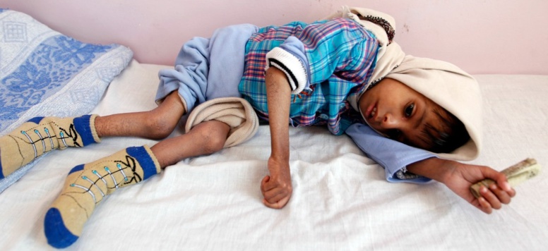 Au Yémen, les familles forcées de choisir lesquels de leurs enfants sauver de la famine