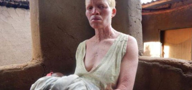 Malawi : les Albinos témoignent : « J’ai tellement peur que je ne dors plus. »