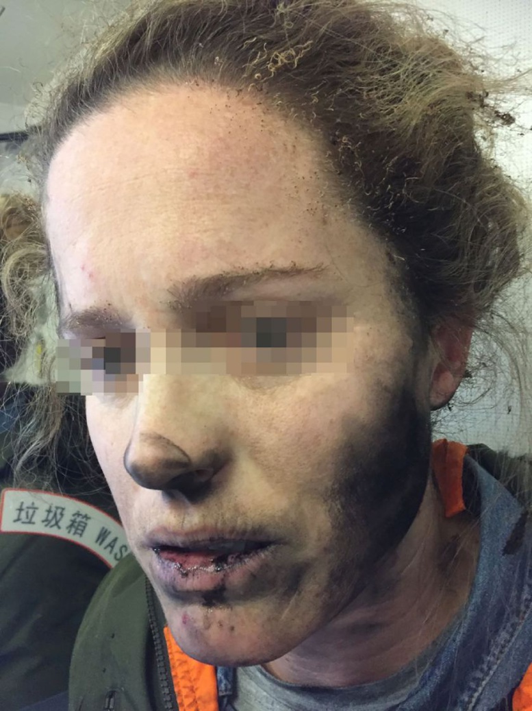Une Australienne brûlée par l'explosion en vol de ses écouteurs Une Australienne brûlée par l'explosion en vol de ses écouteurs