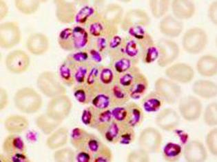 Le paludisme est causé par plusieurs parasites : le Plasmodium falciparum (photo), le plasmodium vivax, le malariae…