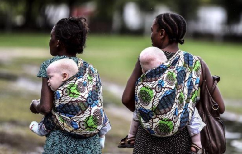 Mali: Une petite fille albinos décapitée, une association dénonce un «crime rituel» Mali: Une petite fille albinos décapitée, une association dénonce un «crime rituel»
