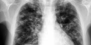 Tuberculose: 16 cas recensés dans la banlieue de Dakar