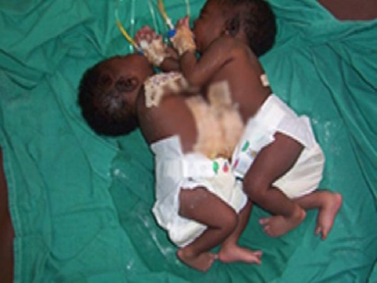 URGENT - Le Professeur Ngom annonce le décès d’une des sœurs siamoises URGENT - Le Professeur Ngom annonce le décès d’une des sœurs siamoises