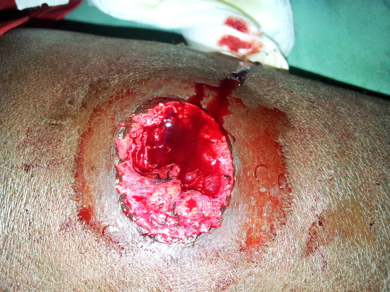 PHOTOS (âme sensible s'abstenir) Manifs du 27 janvier: Un jeune atteint par balle raconte sa tragédie