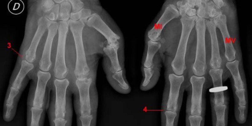 La blogueuse Dédé Didi sensibilise sur la Polyarthrite Rhumatoïde, une maladie incurable et méconnue au Sénégal La blogueuse Dédé Didi sensibilise sur la Polyarthrite Rhumatoïde, une maladie incurable et méconnue au Sénégal