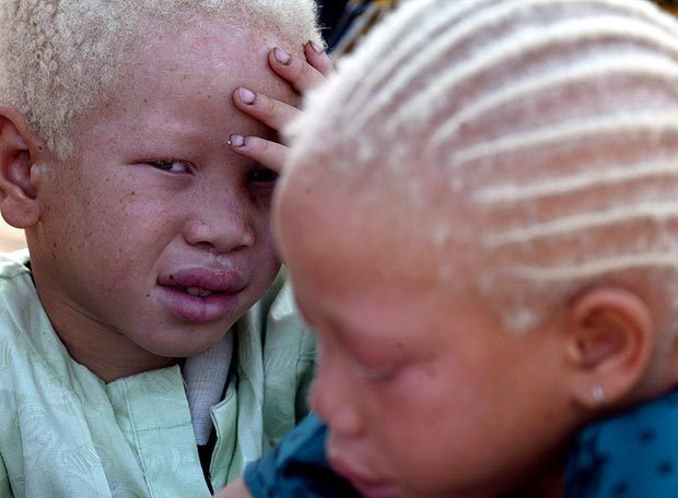 Thiès: « Y’en a marre » se veut l’avocat des albinos et aveugles