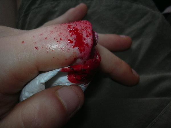 France : une sénégalaise du nom de Maya mord une jeune niçoise et lui arrache le pouce