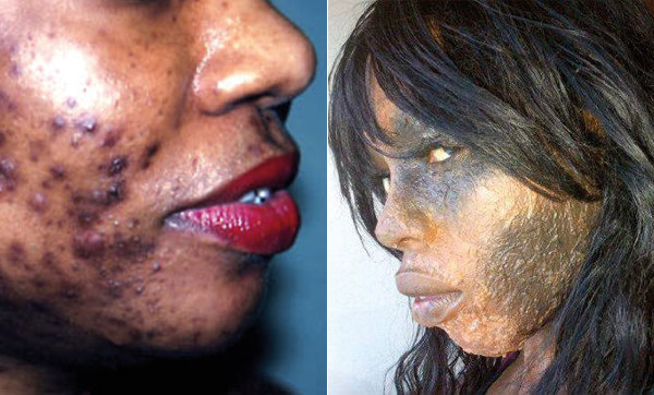 Business des crèmes éclaircissantes: les utilisateurs à la merci des « chimistes cosmétiques » exposent leurs peaux à maints dangers 