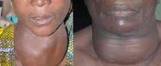 L’Association sénégalaise des malades de la thyroïde plaide pour un diagnostic précoce de la maladie