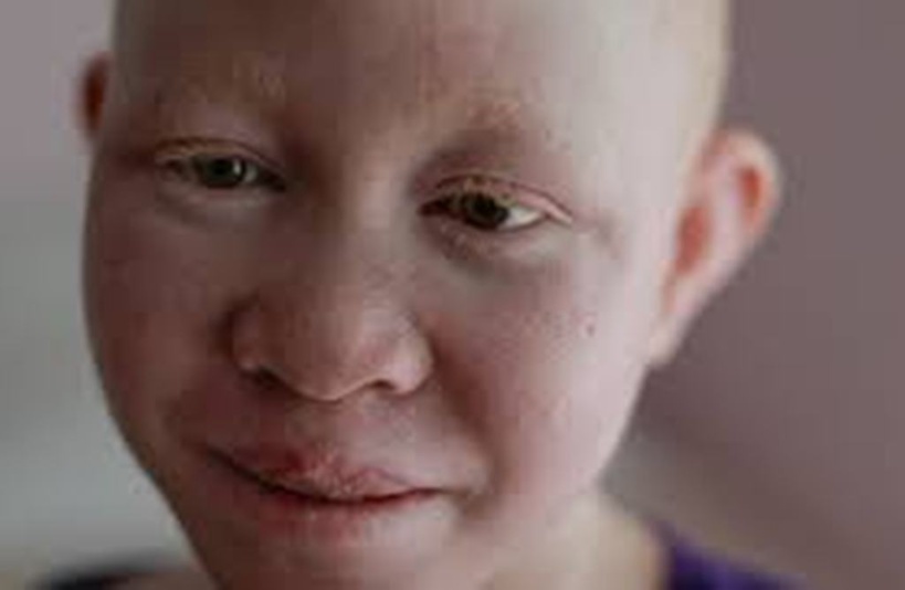 Victime de l’indifférence des populations, les Albinos crient leur ras-le-bol Victime de l’indifférence des populations, les Albinos crient leur ras-le-bol