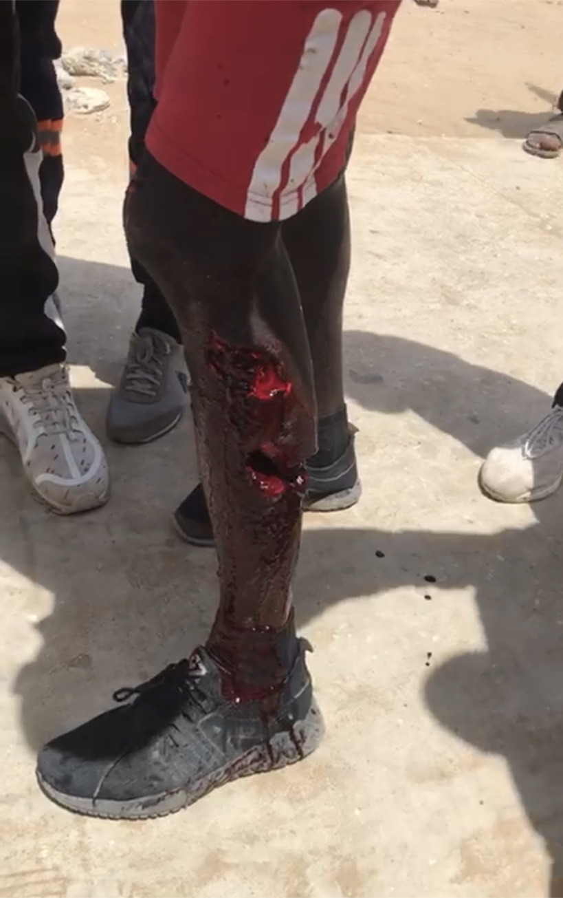 Un étudiant grièvement blessé à l’Ucad: son mollet partiellement emporté par une grenade lacrymogène