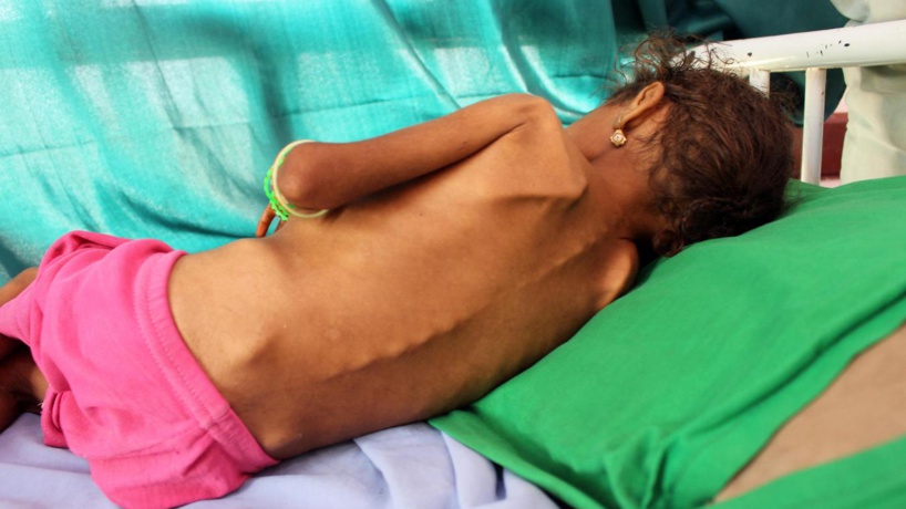 La famine multipliée par six depuis la pandémie