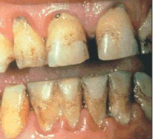 Santé bucco dentaire: Huit (8) pays africains se liguent contre le noma