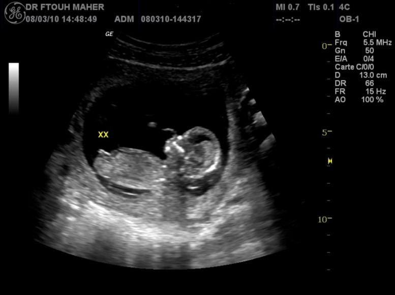 Une colombienne de 82 ans vivait avec un fœtus de 40 ans Une colombienne de 82 ans vivait avec un fœtus de 40 ans