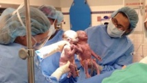 Maxisciences/Gentside Découverte - Jenna et Jullian sont des jumelles rares, elles partageaient le même placenta et le même sac amniotique