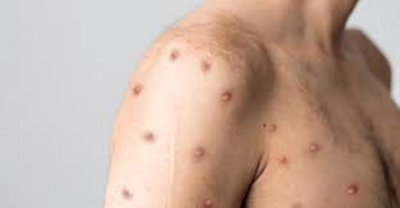 Variole du singe: l'OMS déclenche son plus haut niveau d'alerte