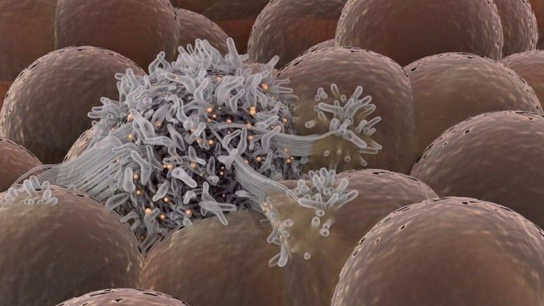 Des innovations qui améliorent les chances des patients atteints de cancer