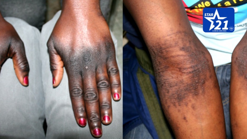 Sénégal : 67 sur 100 femmes se dépigmentent, un combat pour la santé publique Sénégal : 67 sur 100 femmes se dépigmentent, un combat pour la santé publique