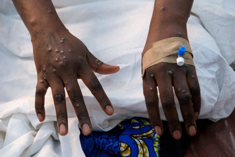 Mpox: l'OMS maintient son plus haut niveau d'alerte Mpox: l'OMS maintient son plus haut niveau d'alerte