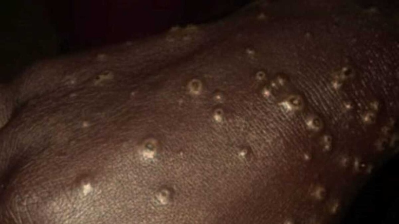 Mystérieuse maladie des pêcheurs de la Petite Côte : une microalgue toxique comme coupable après cinq ans d'incertitude Mystérieuse maladie des pêcheurs de la Petite Côte : une microalgue toxique comme coupable après cinq ans d'incertitude