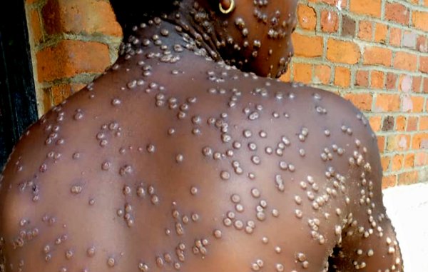 Le Ghana connaît sa plus forte épidémie de mpox depuis 2022