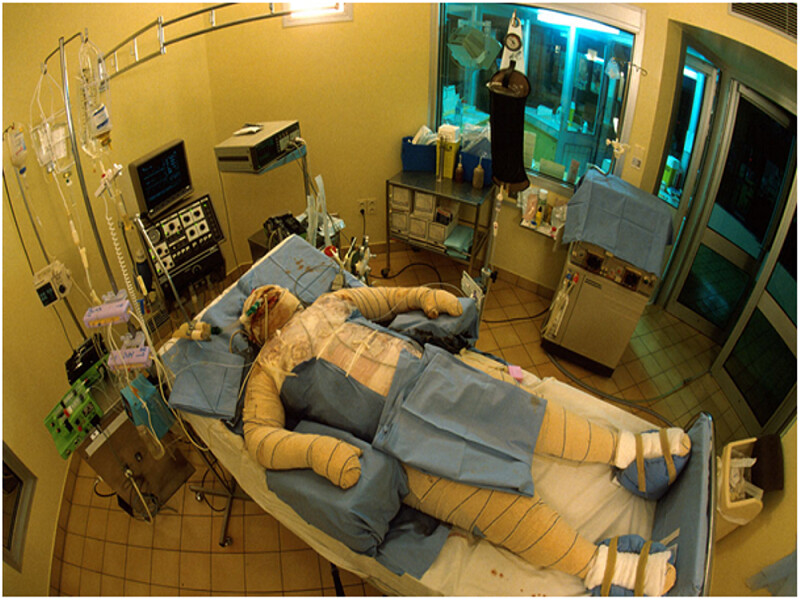 Sénégal : un centre de traitement des grands brûlés voit enfin le jour à l'hôpital Principal de Dakar