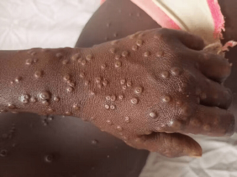 Sénégal : 125 cas suspects de mpox signalés dans plusieurs localités