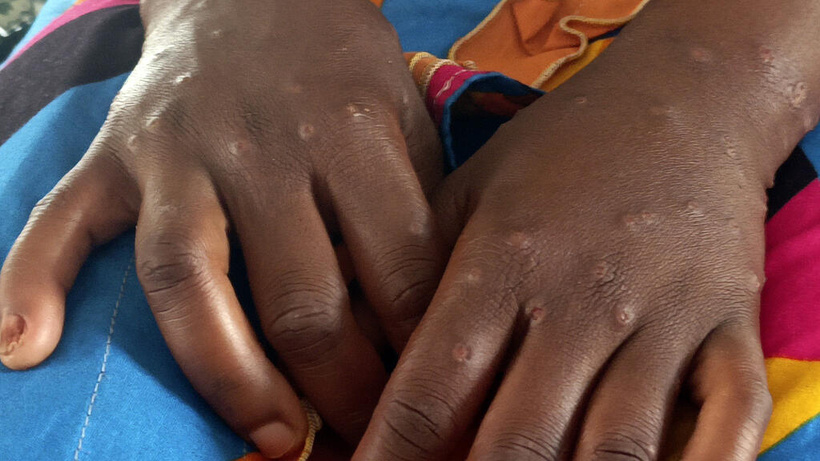 Guinée: l'épidémie de mpox s'étend dans le pays, un an après son apparition Guinée: l'épidémie de mpox s'étend dans le pays, un an après son apparition