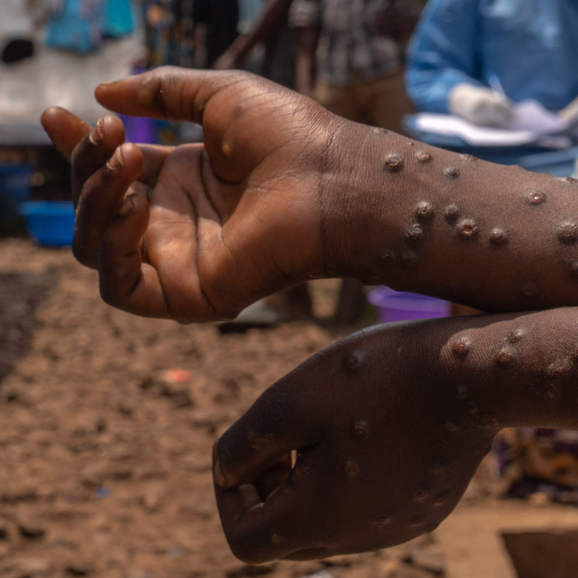 Mpox au Sénégal : un cas confirmé à l’Hôpital de Fann Mpox au Sénégal : un cas confirmé à l’Hôpital de Fann
