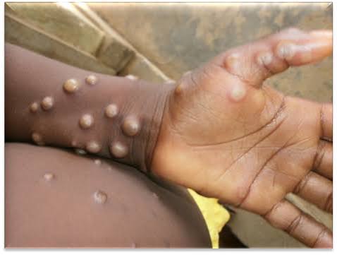  Santé : un deuxième cas de Mpox confirmé à Dakar, 20 contacts identifiés
