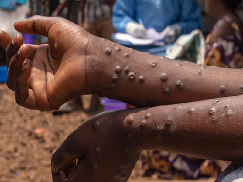 Mpox et Fièvre de la Vallée du Rift : 56 cas dont 8 décès, Richard-Toll, Saint-Louis, Podor, Pété, Louga, Matam et Dakar touchés (Ministère) 