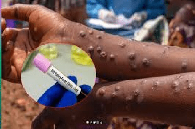 Fièvre de la vallée du Rift : 381 cas confirmés avec 5 nouveaux cas positif à la date du 1er novembre (ministère)