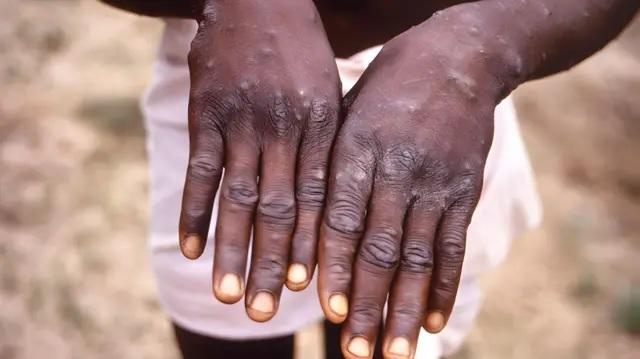 ​Fièvre de la vallée du Rift (FVR) : un nouveau décès et sept (07) cas confirmés au 12 novembre