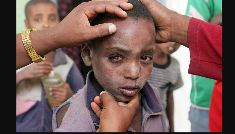 Maladies Tropicales Négligées : le traitement du trachome passe sous la barre des 100 millions FCFA Maladies Tropicales Négligées : le traitement du trachome passe sous la barre des 100 millions FCFA