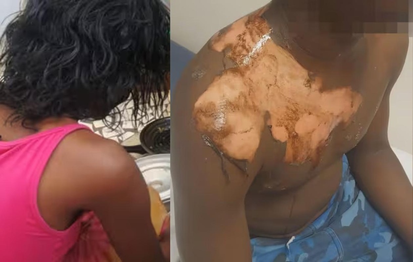 Drame conjugal à Boune : elle verse de la bouillie chaude sur son mari après une dispute Drame conjugal à Boune : elle verse de la bouillie chaude sur son mari après une dispute