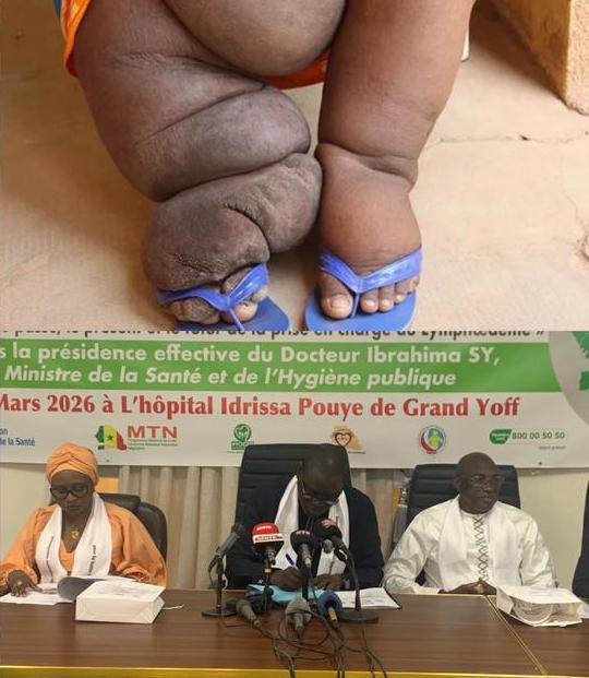 ​Prise en charge de la maladie au lymphœdème : en 4 ans, 2 500 cas ont été confirmés