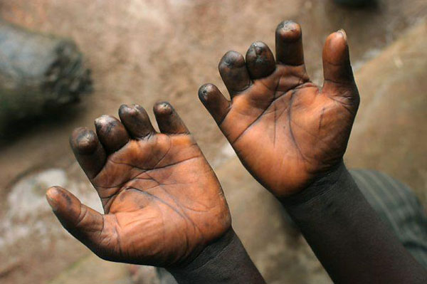 Touba : 83 nouveaux cas de lèpre recensés en 2026