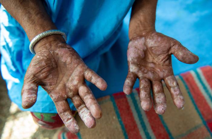 ​Thiès : aucun nouveau cas de lèpre recensé en 2026, après les sept enregistrés en 2025