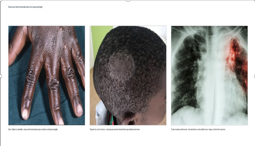 Exemple d'infections évoquées dans le débat (Gale, teigne et tuberculeuse) Exemple d'infections évoquées dans le débat (Gale, teigne et tuberculeuse)