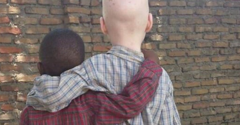 Journée internationale de l'albinisme : la peur au quotidien