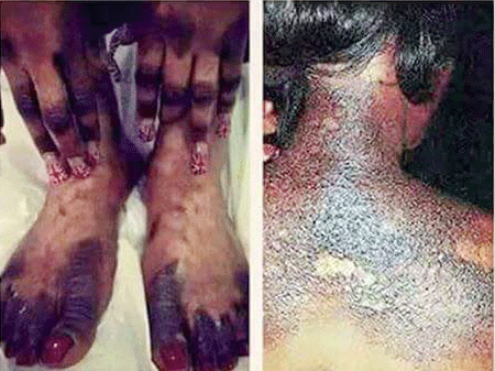 Santé publique : le Dr Ibrahima Ndiaye dénonce les effets dévastateurs de la dépigmentation artificielle