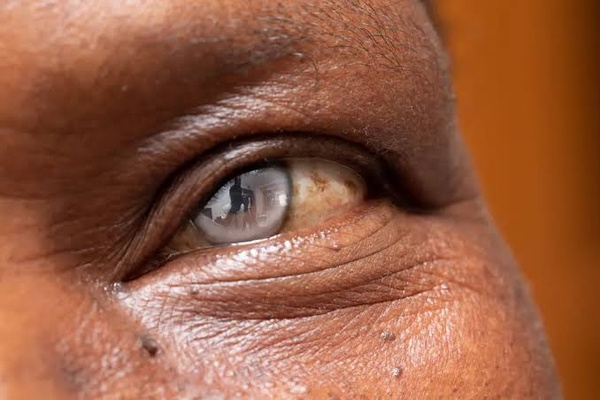 Cataracte et maladies oculaires : 481 opérations gratuites lancées à Yeumbeul
