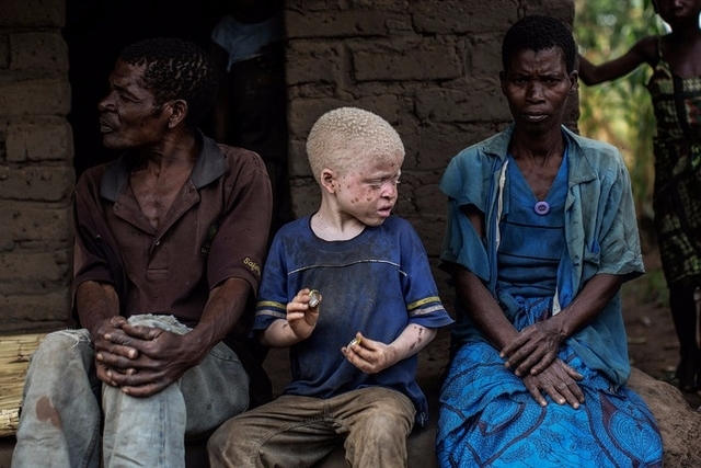 Mozambique : «Les personnes albinos sont pourchassées»