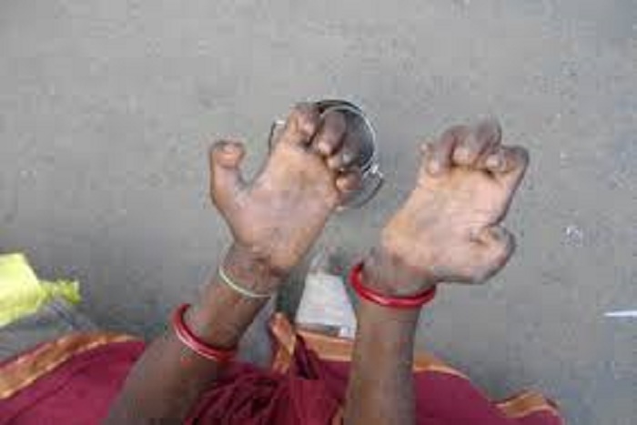 Taux de prévalence de la Lèpre au Sénégal : 254 nouveaux cas recensés chaque année