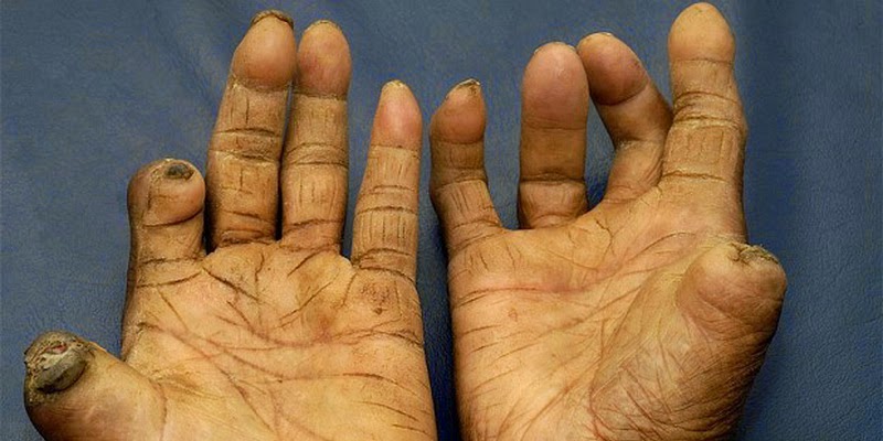 Pourquoi la lèpre résiste au Sénégal ?