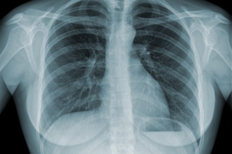 Journée mondiale de lutte contre la tuberculose: 13166 cas enregistrés en 2016 au Sénégal