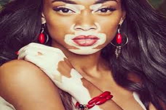 Atteinte de vitiligo, elle fait sensation sur le tapis rouge