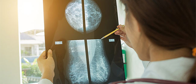 ​Un logiciel calcule pour chaque femme le risque de cancer du sein