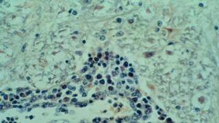 Afrique du Sud: la listériose a tué 61 personnes en 2017