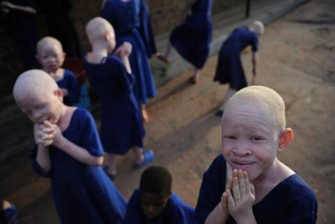 Journée de l’Albinisme : comment ‘’ vivre sous le soleil’’ au cœur des débats